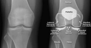 radiografia de joelho com bico de papagaio